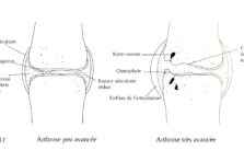 Arthrose du genou et course à pied